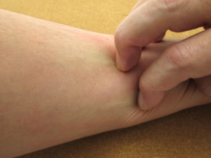 アトピー性皮膚炎はやっかいなアレルギー症状
