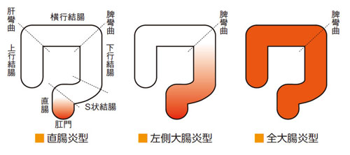 潰瘍性大腸炎は（１）直腸炎型（２）左側大腸炎型（３）全大腸炎型と3つに分類されます