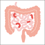 クローン病の分類「小腸クローン病」
