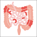 クローン病の分類「小腸・大腸クローン病」 