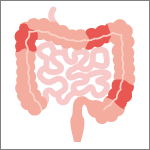 クローン病の分類「大腸クローン病」 