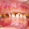 子供の口腔崩壊が危ない！虫歯のない歯は全身の健康につながる！