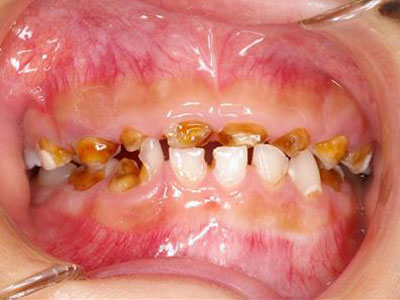 口腔崩壊は、虫歯を10本以上有していたり、歯根か残っていないような歯を有することを示します